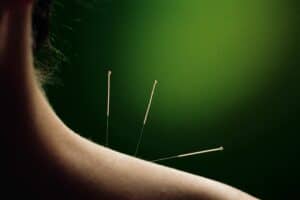 Acupuncture